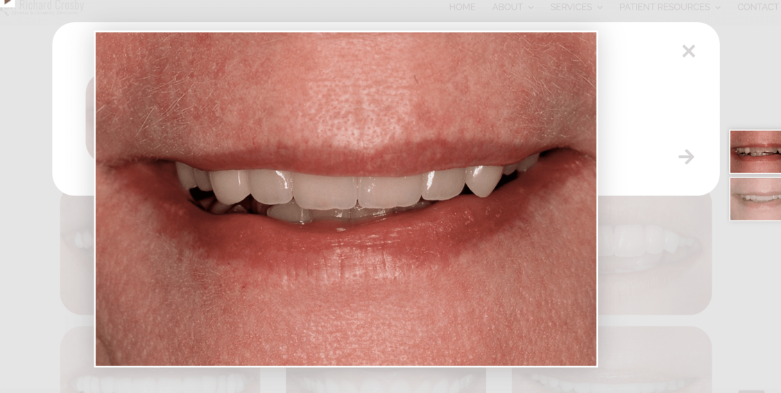 Close-up of a person's mouth showing teeth with gaps and dental issues.